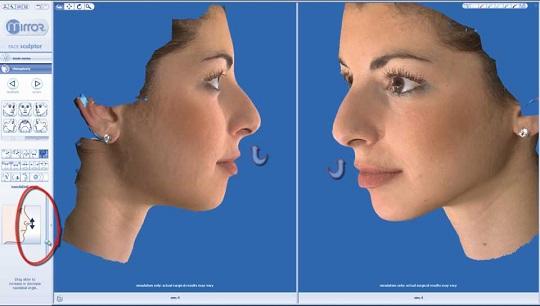 Ρινοπλαστική : Ανασήκωμα του κάτω μέρους της μύτης