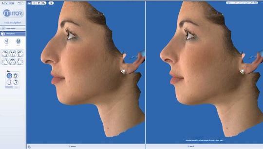 Ρινοπλαστική Προσομοίωση - Πριν & Μετά την πλαστική στη μύτη