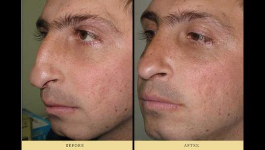 Ρινοπλαστική : Πριν και Μετά την πλαστική στη μύτη Περίπτωση 2