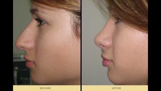 Ρινοπλαστική : Πριν και Μετά την πλαστική στη μύτη Περίπτωση 3