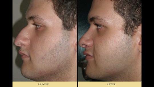 Ρινοπλαστική : Πριν και Μετά την πλαστική στη μύτη Περίπτωση 4