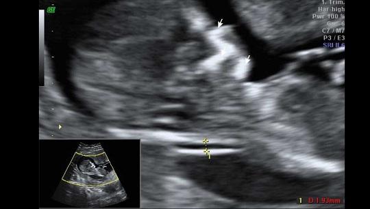 Αυχενική Διαφάνεια : Υπερηχογράφημα στο 1ο Τρίμηνο εγκυμοσύνης