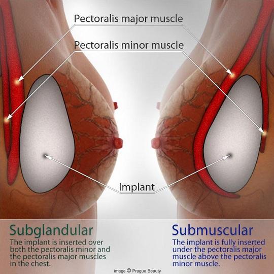 Αυξητική στήθους : Τοποθέτηση Ενθεμάτων Σιλικόνης