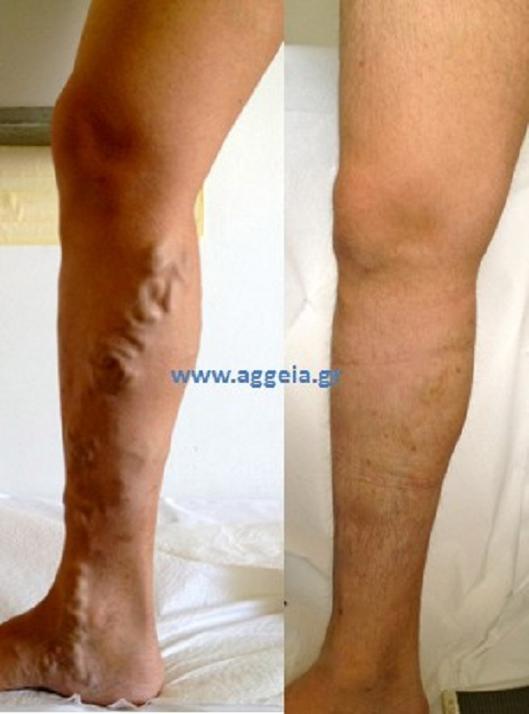 Κιρσοί στα πόδια : Πριν & μετά τη θεραπεία