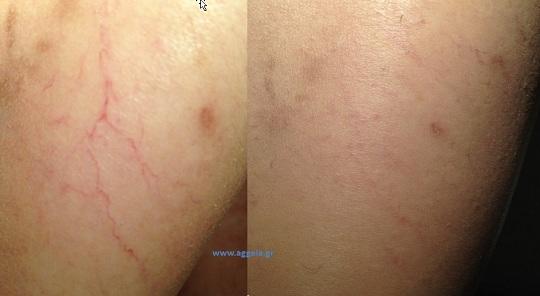 Ευρυαγγείες στα πόδια : Φωτογραφία ασθενούς πριν και μετά την κατάλληλη θεραπεία