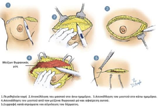 Μαστεκτομή - Απλή μαστεκτομή