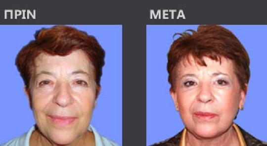 Λίφτινγκ προσώπου. Face Lifting. Περιστατικό Β.