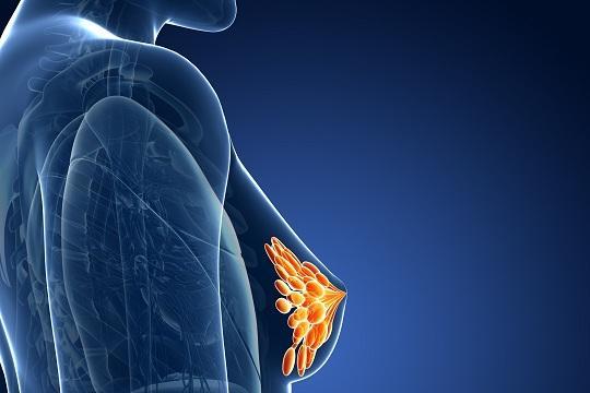 Όγκος στο στήθος - Καρκίνος στο στήθος - Καρκίνος μαστού