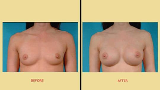 Πλαστική στήθους : Πριν & μετά την αυξητική στήθους - Μπροστινή όψη