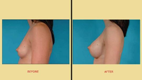 Πλαστική στήθους : Πριν & μετά την αυξητική στήθους - Πλαινή όψη