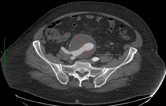 Γιγαντιαίο ανεύρυσμα της ΔΕ κοινής λαγονίου αρτηρίας (διάμετρο= 8,5 εκ.) που καταλάμβανε και τις εκφύσεις της έσω και έξω λαγονίου αρτηρίας σε συνδυασμό με ανεύρυσμα κοιλιακής αορτής