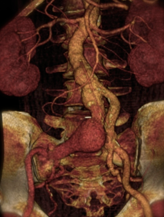 Αξονική αγγειογραφία του ασθενούς πριν και μετά την ενδαγγειακή    αντιμετώπιση όλων των ανευρυσμάτων. Εικόνα 2