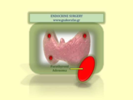 ti einai o yperparathyreoeidismos; poia ta symptomata kai i adimetopisi