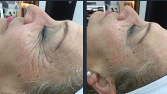 PLASMA mi xeiroyrgiko facelift fwtografia prin kai meta