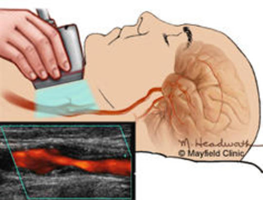 στένωση καρωτίδας υπέρηχος θεραπεία