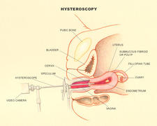 υστεροσκόπηση διάγνωση θεραπεία γυναικολογικά προβλήματα