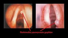 πολύποδες φωνητικών χορδών