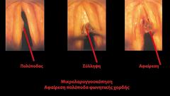 αφαίρεση πολύποδα φωνητικών χορδών