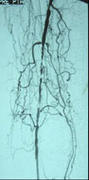Μηριαία αρτηρία ασθενούς πριν και μετά την αγγειοπλαστική. Η εικόνα στα αριστερά απεικονίζει σοβαρά στενωμένη μηριαία αρτηρία.