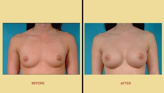Αυξητική στήθους. Πριν & Μετά, μπροστινή όψη